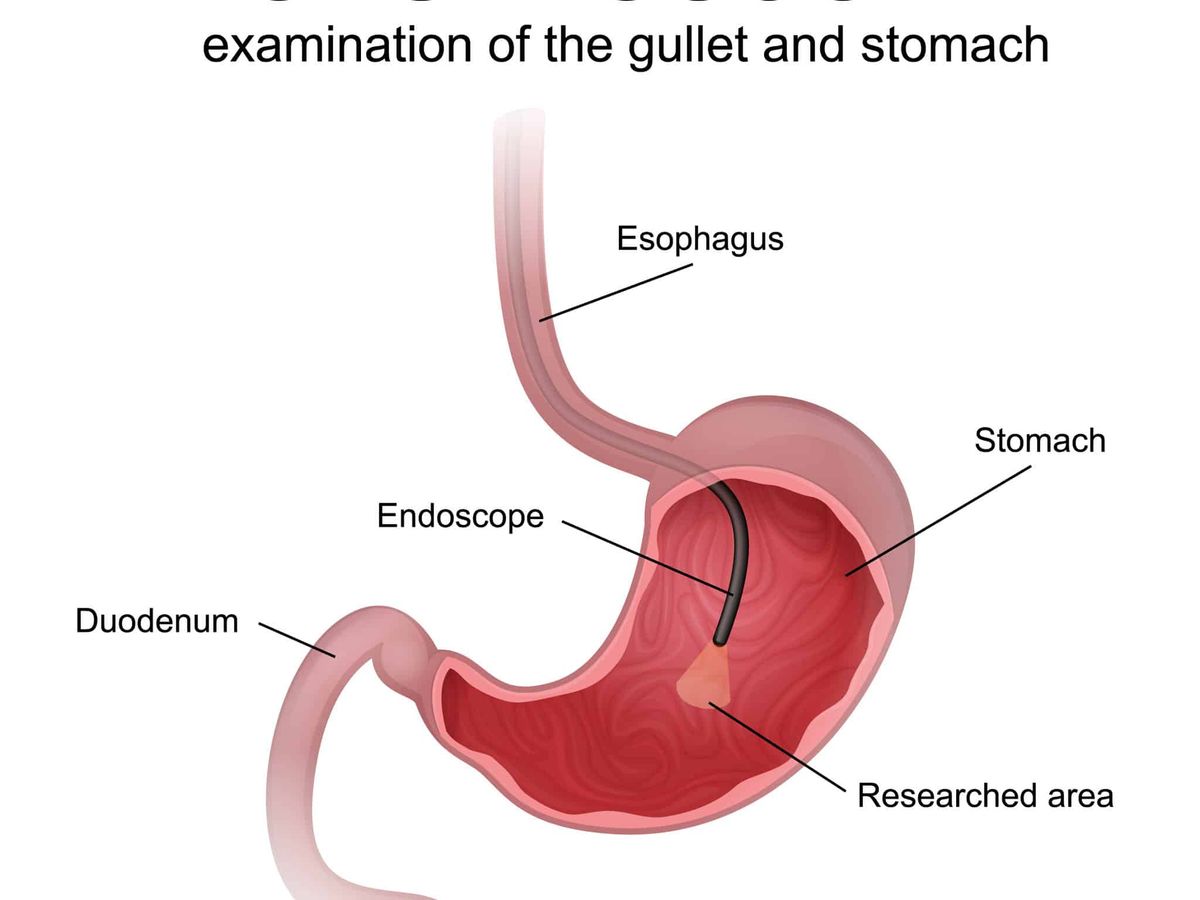 Understanding Gastroscopy