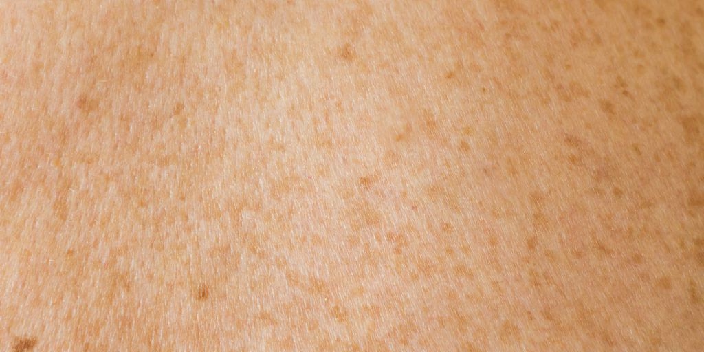a close up of a person's back with brown spots