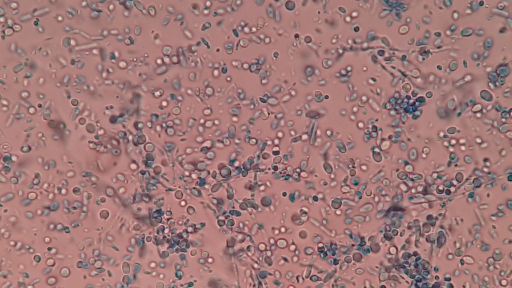 Understanding Yeast Infections Causes, Symptoms, and Treatment