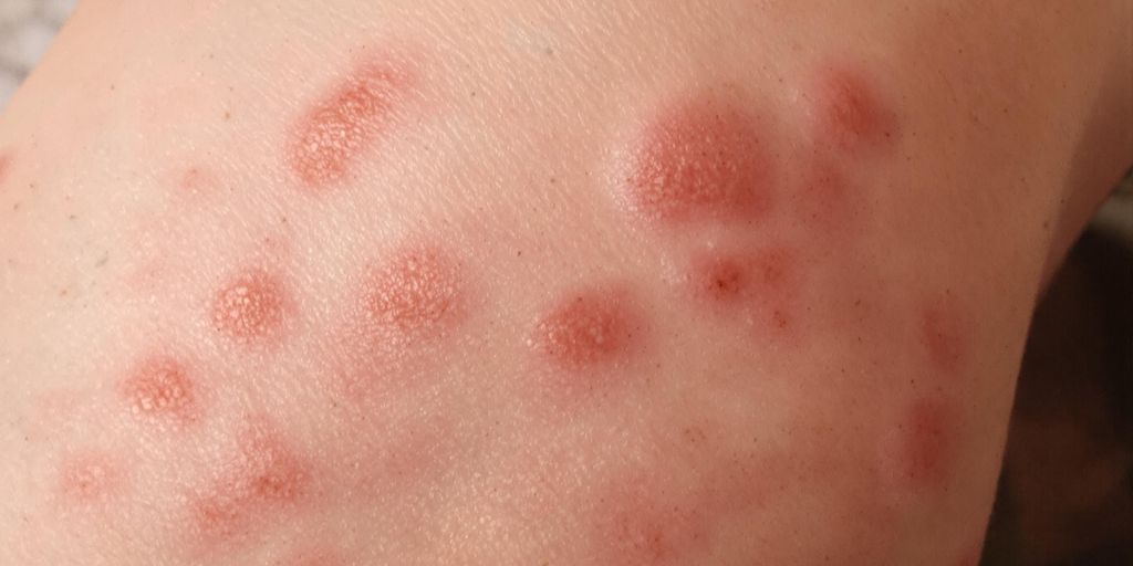 Mușcăturile de ploșnițe pe piele umană.