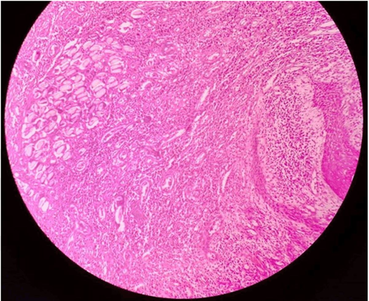 pilonidal cyst herbal remedies