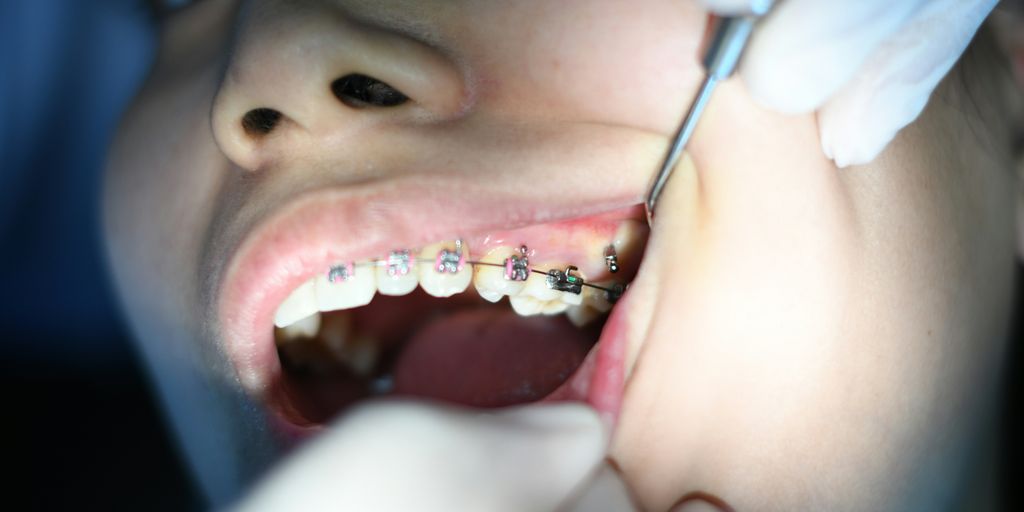 person with silver teeth braces