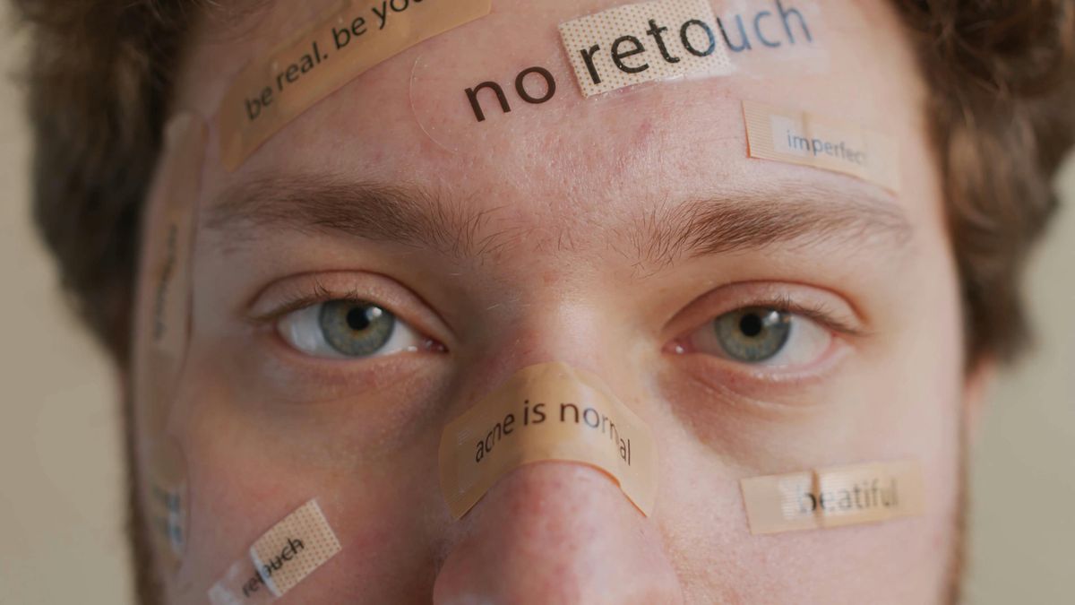 The Surprising Culprits Behind Acne