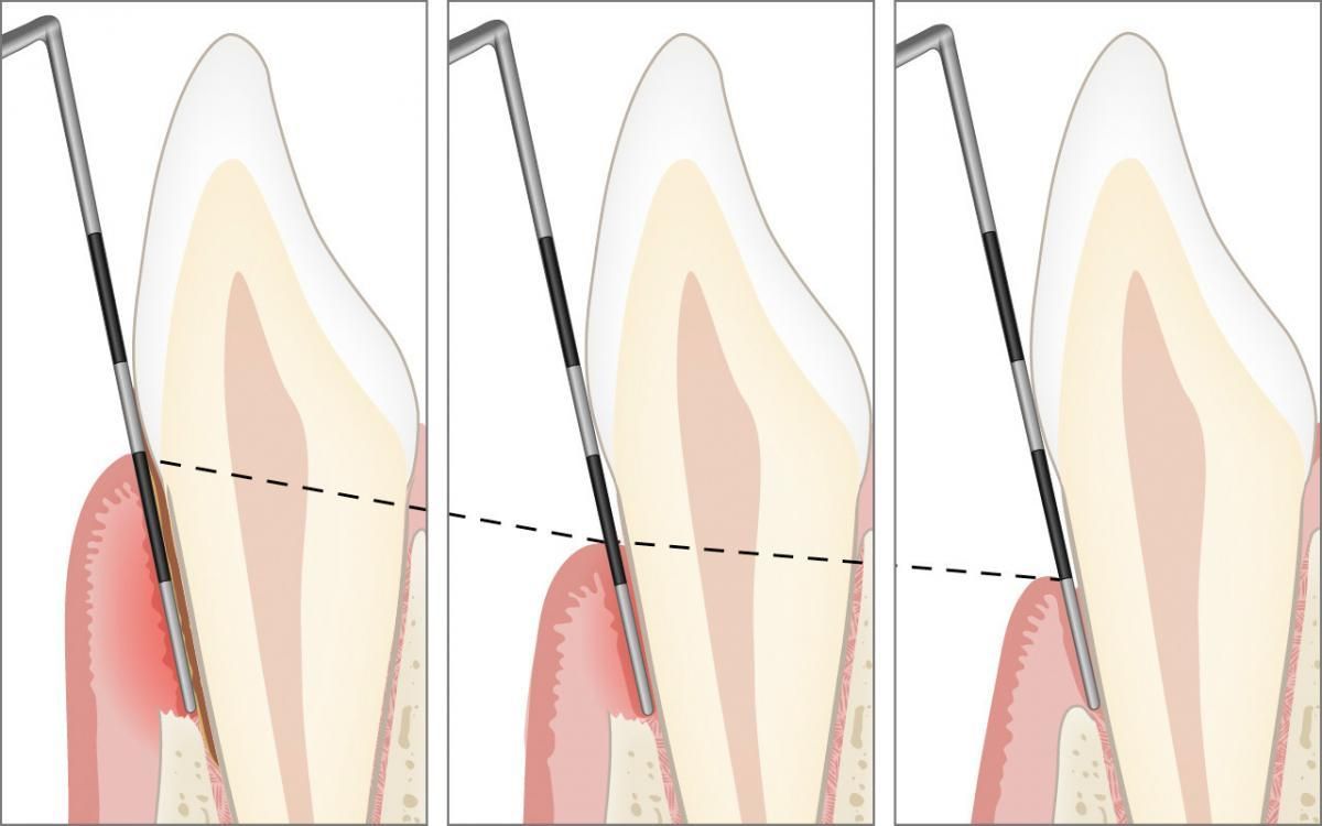 Warum Interdentalbürsten unverzichtbar sind
